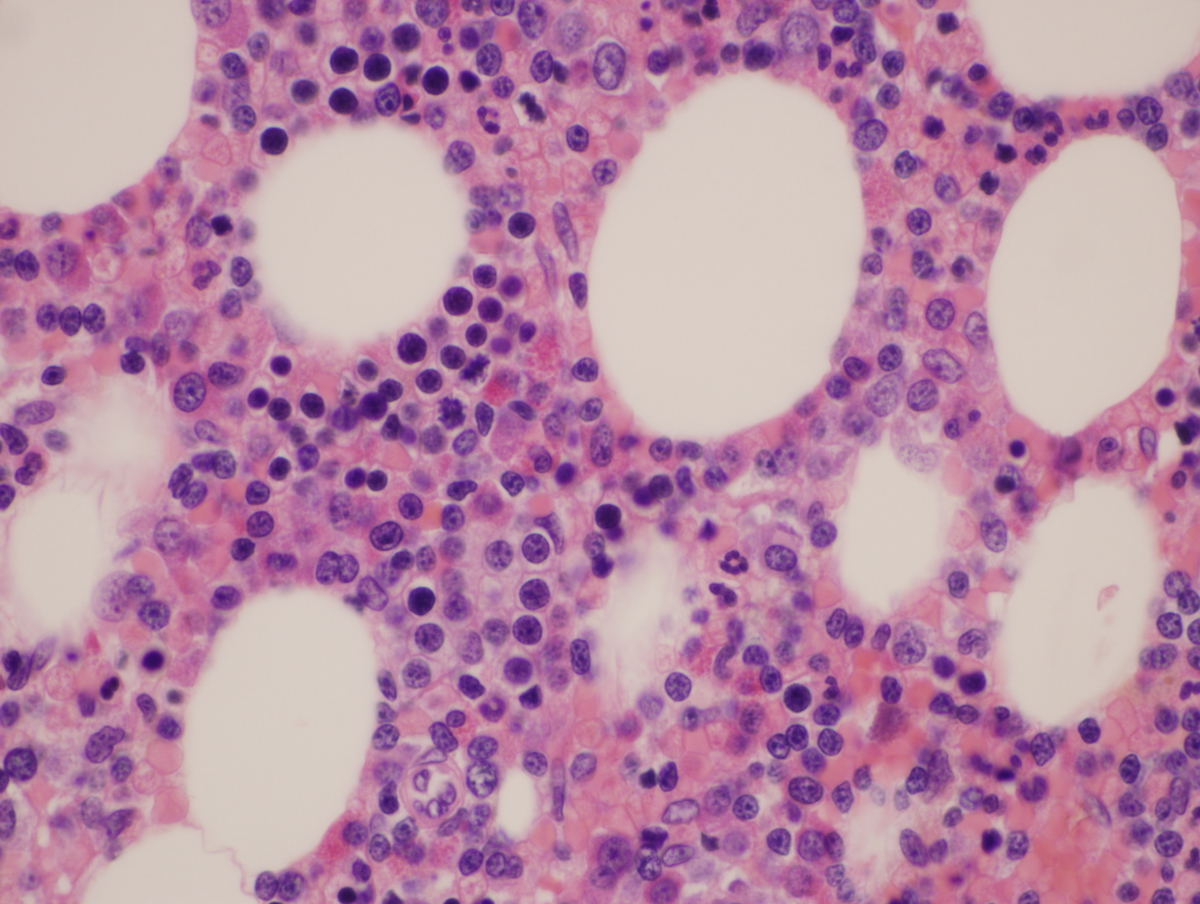 Clot section.